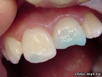 гипоплазия зуба