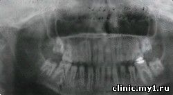 Снимок панорамной рентгенограммы зубов