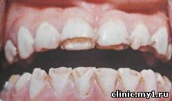 Порок развития зубных тканей