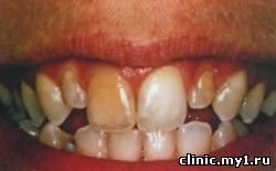 Зубы после травмы