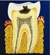 Кариес зубов