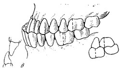 Прогения зубов